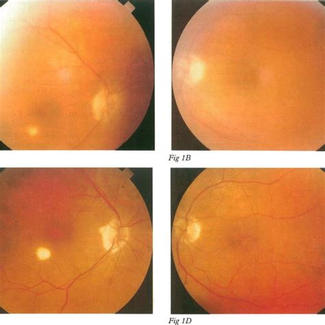 Pdf Severe Course Of Cutaneous Melanoma Associated Paraneoplastic Retinopathy