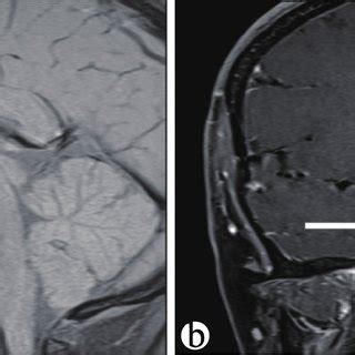 A T1 Weighted MRI Sagittal Images Showing Large Intrasellar Mass