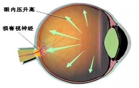 不可逆致盲性眼病——青光眼，你了解多少？ 知乎