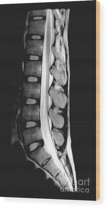 Healthcare Extreme How To Read An Mri Lumbar Spine In Easy 43 Off