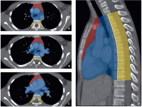 Mediastinum | Radiology Key