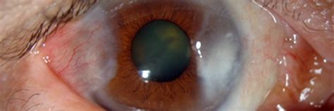 Pterygium - IRIS Surgery