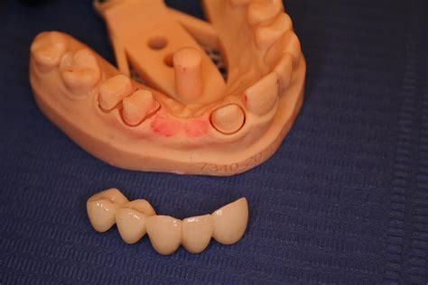 Algemene Tandheelkunde Tand Implant