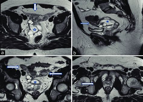 Magnetic Resonance Imaging Of The Pelvis Showing Various Structures