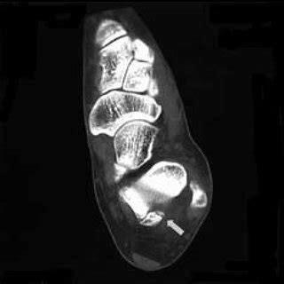 (PDF) Fracture of the Os Trigonum: A Case Report