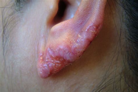 Skin Tuberculosis (TB): Overview and More