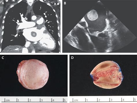 Left Atrial Thrombus Someone Somewhere