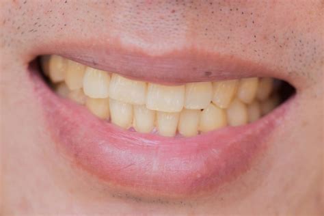 8 Major Causes Of Yellow Stains On Teeth