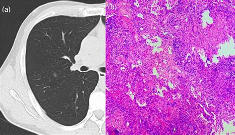 Frontiers Ct Imaging Indications Correlate With The Degree Of Lung Adenocarcinoma Infiltration