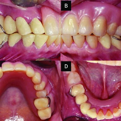 Intraoral Photographs Of Provisional Restorations At The Newly