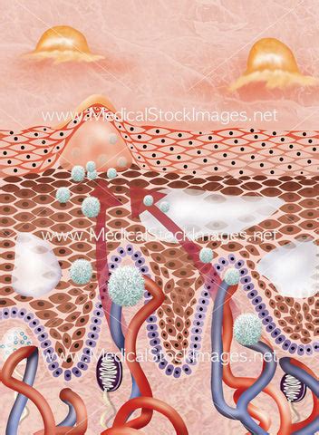 Stages of Eczema - Labelled – Medical Stock Images Company