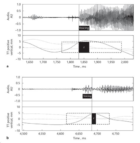 Acoustic Waveforms Top Panels In A And B And Tongue Tip Tt