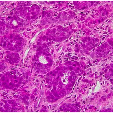 Histopathology Of Adenosquamous Carcinoma Stain Hsp Magnification