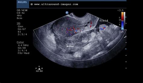 Cochinblogs Sonography Of Ectopic Pregnancy