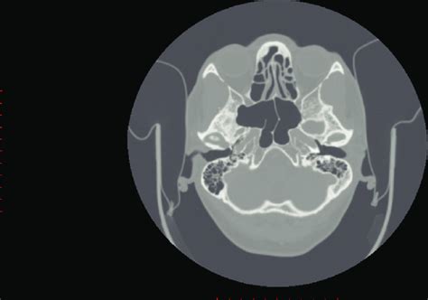 Axial Computed Tomography Image Complete Intersphenoid Septum Inserted