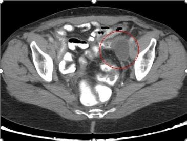 Ct Image Revealed Left Side Lymphocele Along Left External Iliac