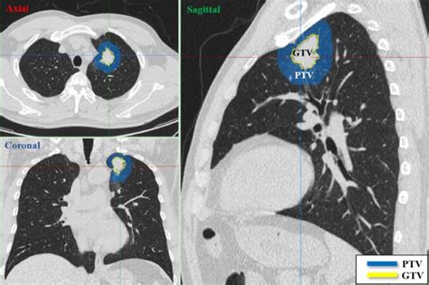 Eur Radiol：融合瘤周影像特征的影像组学建模新思路 Medscicn