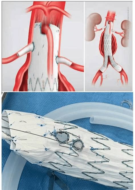 5 Fenestrated Stent Graft Used For The Treatment Of Perirenal Aortic Download Scientific