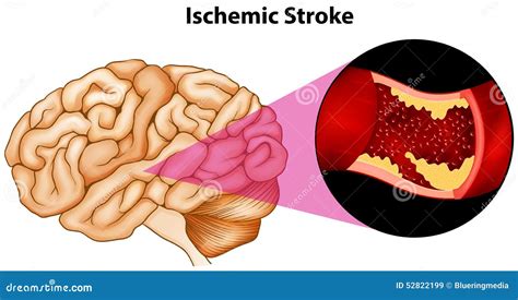 Brain Stock Illustration - Image: 52822199