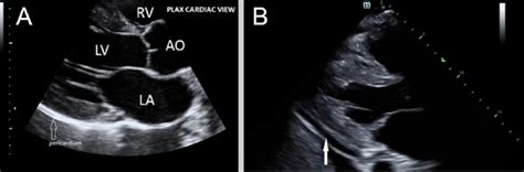 A Focused Cardiac Ultrasound Focus Parasternal Long Axis View