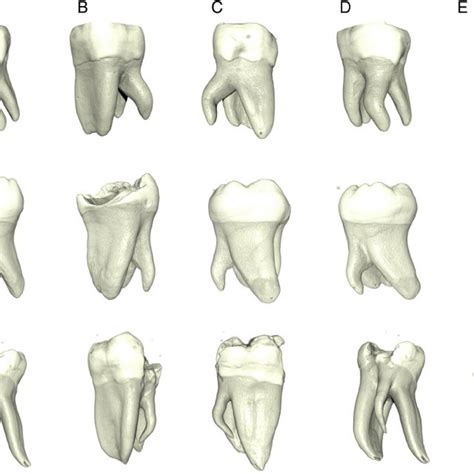 3D Models Showing The External Anatomy Of 3 Mandibular Molars In Which