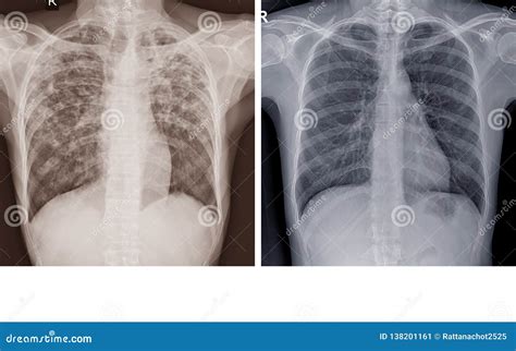 Tuberculosis Lung X Ray