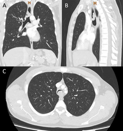 The Computed Tomography Scan Of A 38 Year Old Male With An Endotracheal Download Scientific