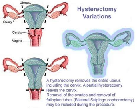 Instrumentación quirúrgica Histerectomia Abdominal