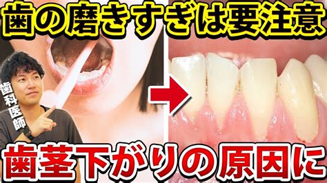 【歯茎下がり】歯の磨きすぎで歯茎が下がる？対処法を歯医者が解説！ Youtube