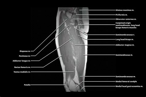 MRI - THIGH