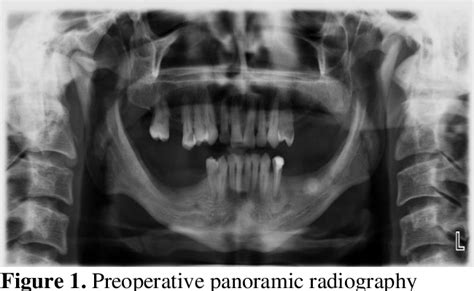 Figure 1 From Sialolith Of The Submandibular Gland A Case Report