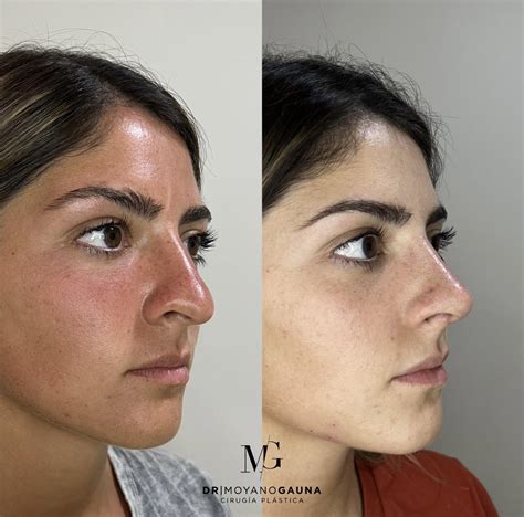 Rinoplastia antes y después Doctor Moyano Gauna