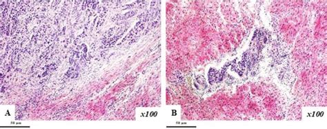 Metastatic Involvement Of The Heart A Intramural Metastases B Tumor Download Scientific