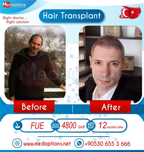 Hair Transplant Istanbul in Turkey before after photos from customers