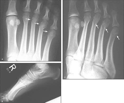 Metatarsal Head