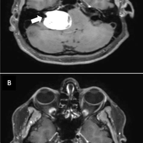 Pre Operative And Post Operative Mri A Preoperative Axial Mri T1 Gad Download Scientific