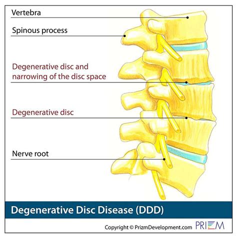 Degenerative Disc Disease Treatment in Reno and Carson City | Swift Institute