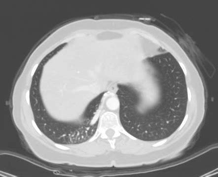 Pulmonary Sequestration Radiology Case Radiopaedia Org