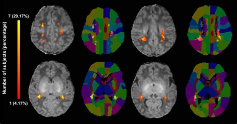 Figure Probabilistic Punctate White Matter Lesion Pwml Maps Of The