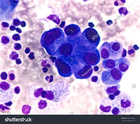 Malignant Cells In Pleural Fluid