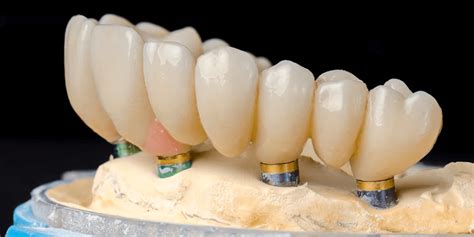 All On 4 Dental Implants Cost Breakdown Everything You Need To Know