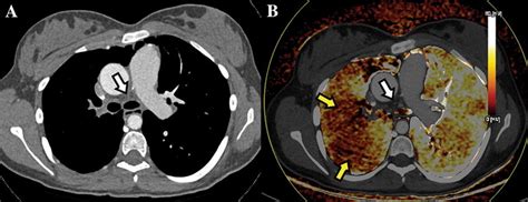 Proximal Pulmonary Artery Interruption A Axial Anatomic And B Axial