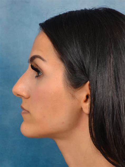 Patient 141137449 Rhinoplasty Before And After Images Dr Sidney Starkman