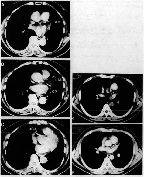 Figure 2 from Coronary Artery Calcification Detected by CT: Clinical ...