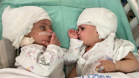 Twins conjoined at the head are separated after 12-hour surgery in