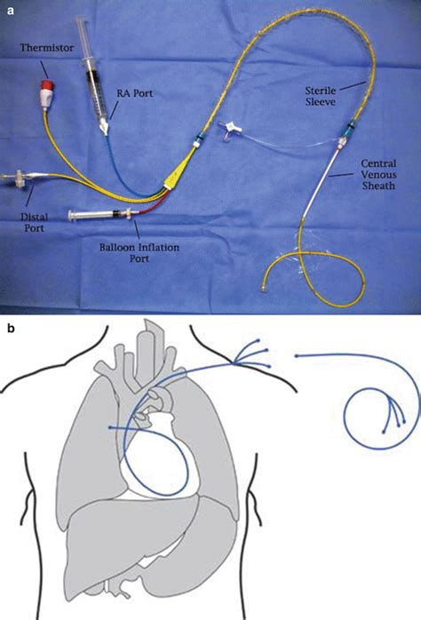 Right Heart Catheterization Thoracic Key