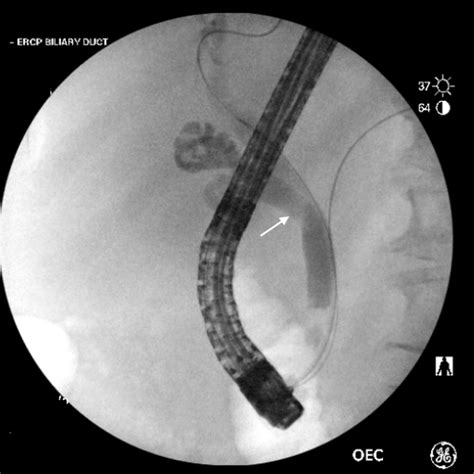 Ercp Revealing A Filling Defect White Arrow Consistent With A Stone Download Scientific