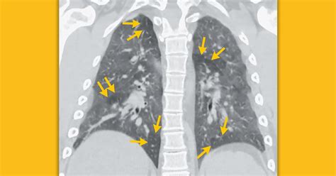 Nejm On Twitter A Year Old Man Presented To A Va Pulmonary Clinic