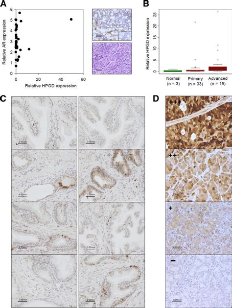 HPGD Expression In Prostate Cancer Samples A Relative HPGD And AR