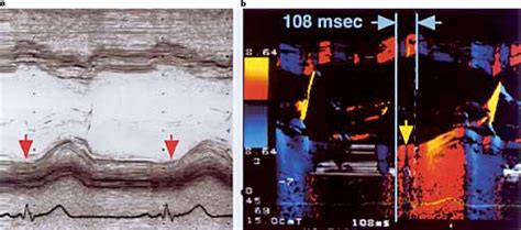 Figure 2 From Detection Of The Earliest Ventricular Contraction Site In